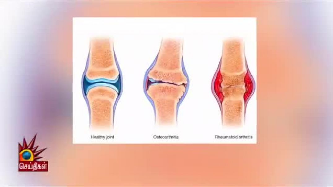 Best knee replacement surgery in chennai