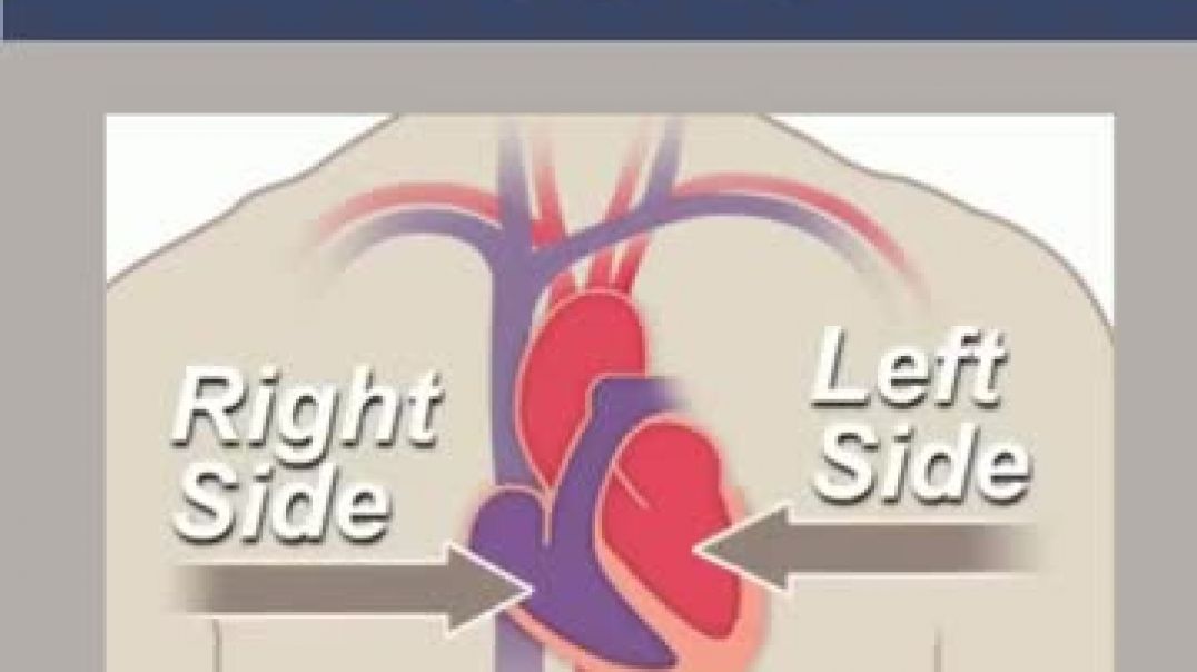 Intravascular Shock wave Lithotripsy in Chennai